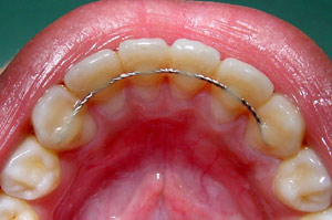 Why Do Teeth Relapse After Wearing Braces?