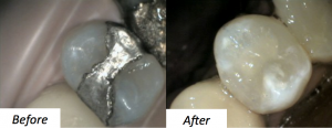 Replacing old dental fillings