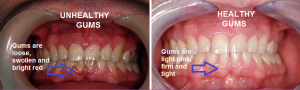 holly-made-gum-disease1