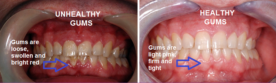 Managing Gum Disease | Vivid Dental