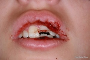 child tooth trauma