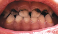 baby teeth cavities