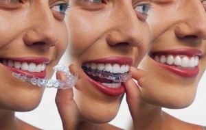 invisalign is the ideal alternative to braces