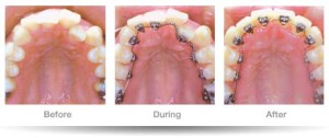 pic_dental-lingual-braces02