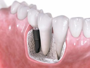 dental implants replace missing teeth