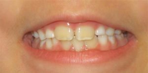 childs front teeth yellow