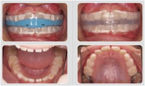 http://vividdental.com.au/wp-content/uploads/2017/11/Myobrace03-300x179.jpg