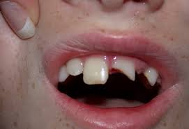 Sports Injury - Cracked Tooth